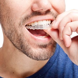 Man inserts clear Invisalign braces into his mouth