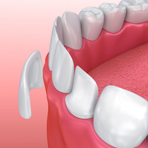 3D Rendering of Dental Veneers