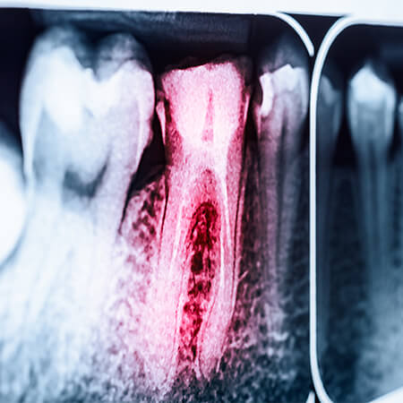 X-ray of infected tooth